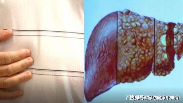 原创专家提醒肝癌进入晚期身体或有4种异常别忽视了