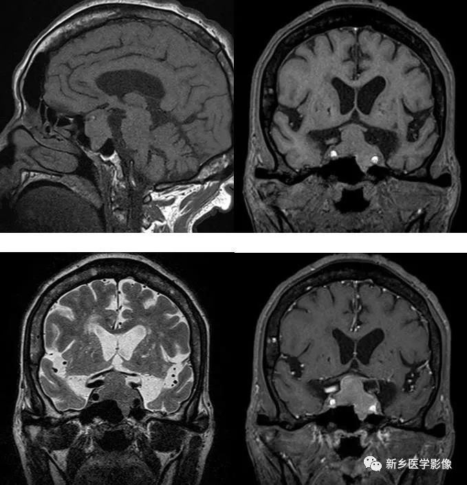 垂体瘤mr图像