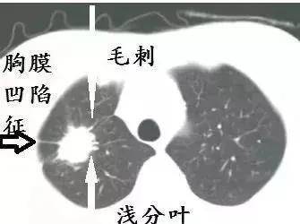 圆形结节更可能是良性的,而"毛刺状"结节,或有不规则或小叶边缘的结节