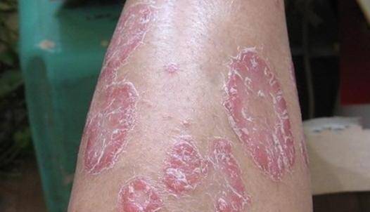 银屑病 6,真菌感染 表现:常表现为癣,皮肤瘙痒,越抓越痒,形成硬痂.