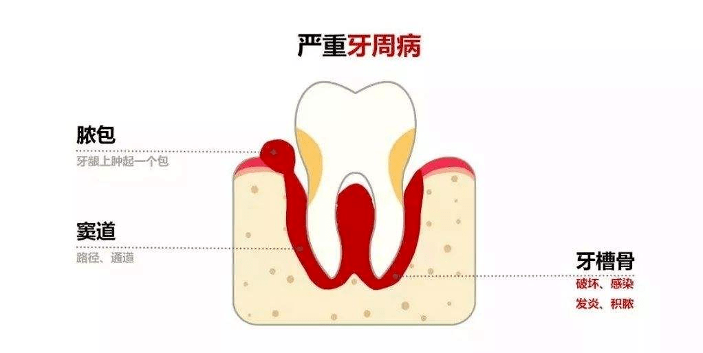 可以很明显的看出来,患有牙周病的患者,牙齿牙结石分布很多,牙龈萎缩