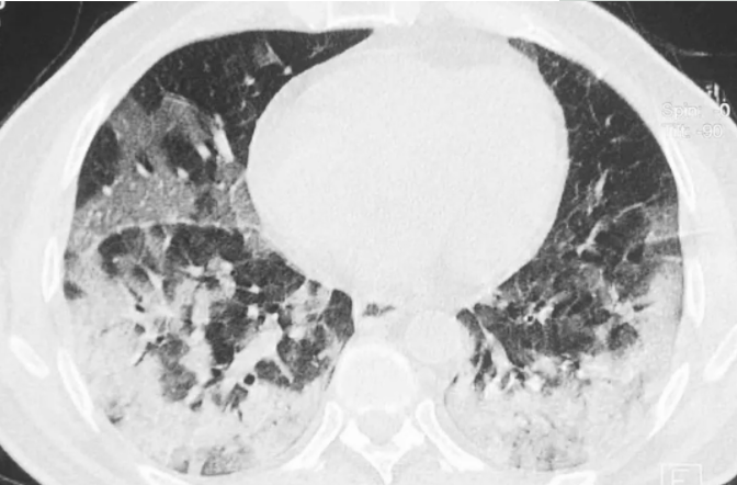 被毛霉菌感染的肺部照片