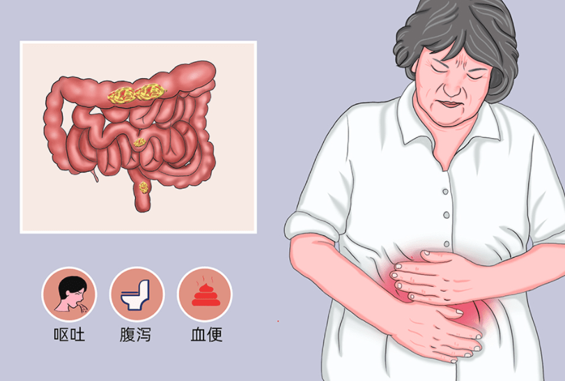 夏季需严把饮食关女子吃炸鸡突发肠梗阻医生妙手除急症