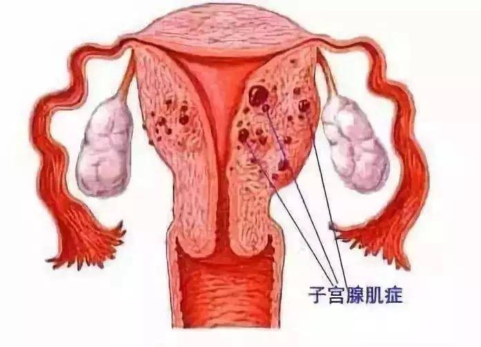 主要表现为 经量增多,经期延长以及逐渐加剧的痛经,子宫呈均匀性增大