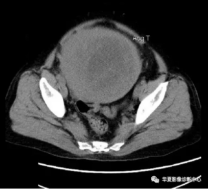 经典盆腔巨大肿块ct诊断与鉴别