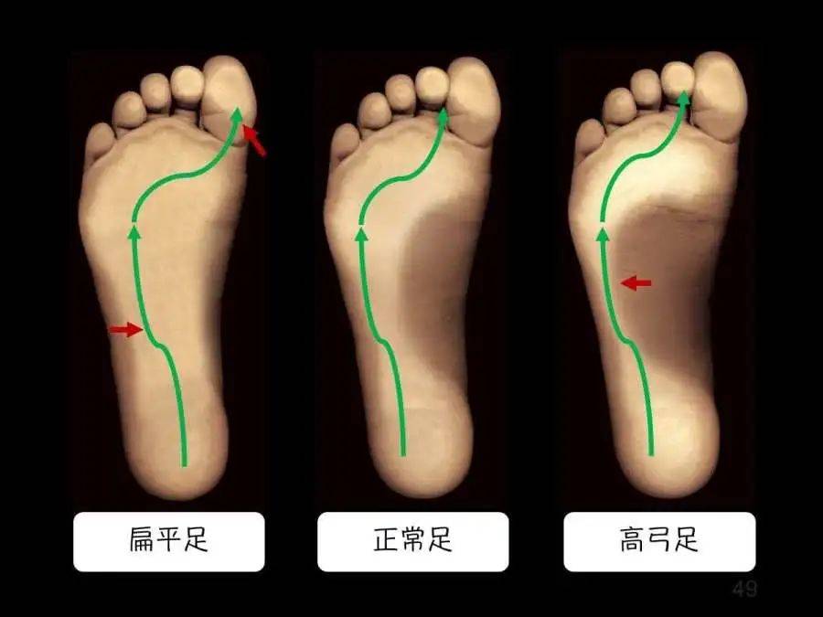 四种类型的高弓足别等严重了才发现