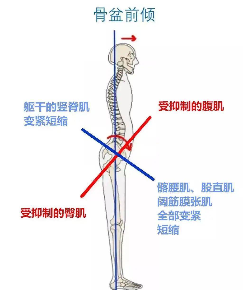 好看还能"翻杯"?别闹,你可能是骨盆前倾