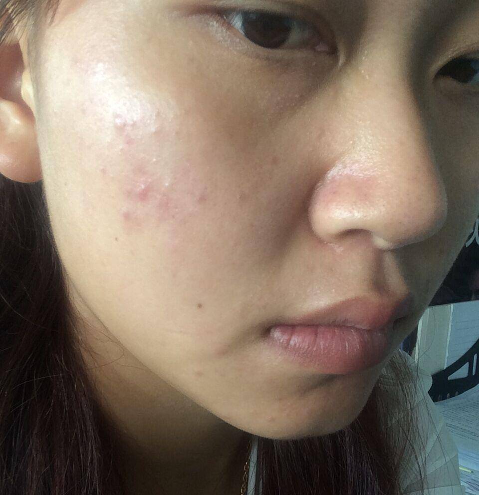 38岁女子脸上长"痘痘",查出hpv感染,医生提醒:1件事少