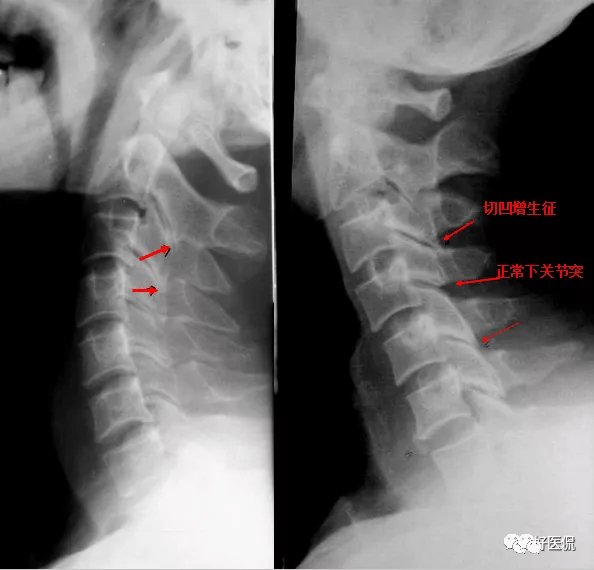 上位颈椎下滑后移,下关节突伸长变尖硬化,刺激棘突根部上缘产生凹陷