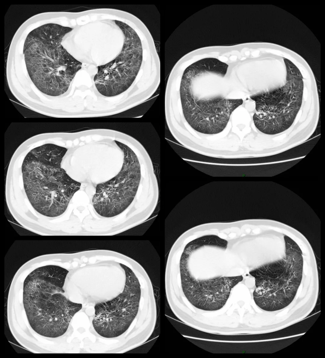 双肺弥漫性磨玻璃密度影,这个典型病例请收好