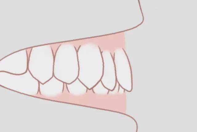 牙齿不整齐 错颌畸形又称牙齿不齐,是指儿童生长发育过程中,由先天的