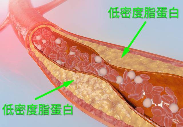 原创"低密度脂蛋白偏高"是否可以理解为心血管堵塞?该怎么处理?