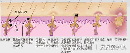 痘痘的形成流程为油脂旺盛,毛孔堵塞→炎症