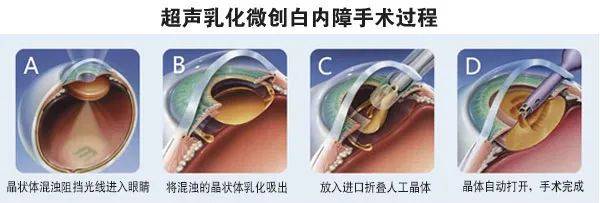 炎热的夏天真的不适合做白内障手术吗?