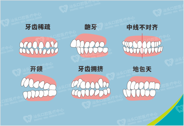 一些错颌畸形如果不及时纠正,可能会由牙性,或者由不良习惯,功能性