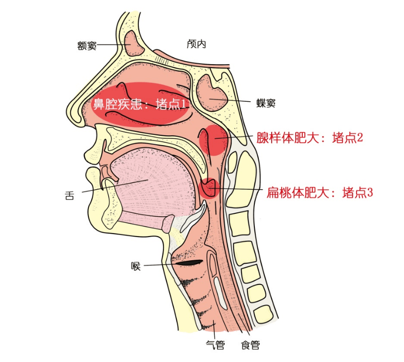 流涕,长期慢性咳嗽, 小小年纪就听力下降及越长越丑(即"腺样体面容")