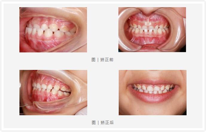 此外,牙博士数字化矫正中心,为3—12岁存在错颌畸形及不良口腔习惯