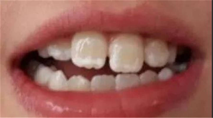 牙齿出现白斑是什么情况?那可能,离龋齿不远了!