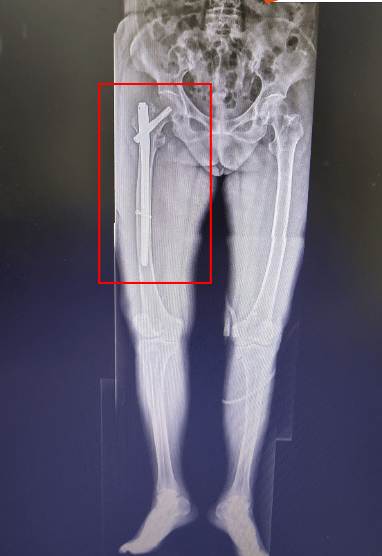 91岁老人骨折命悬一线,惠民专家成功手术挽救生命!