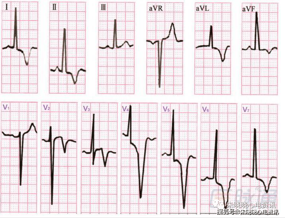 心尖肥厚型心肌病心电图改变