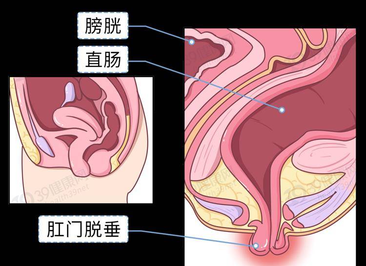 简单来说就是 肛管,直肠(严重时乙状结肠也会) 从肛门垂脱向外翻出的