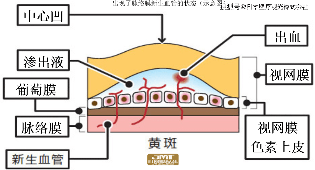 jmt日本医疗-脉络膜新生血管原因是什么?怎么治?