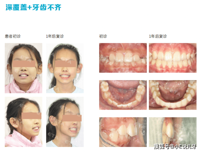 eta矫正器可以改善脸型吗