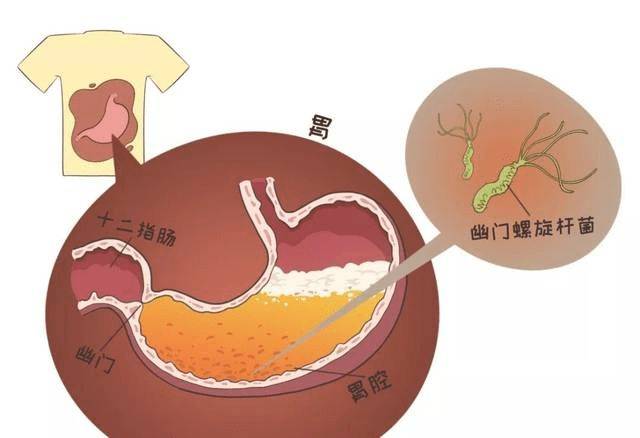 胃窦hp阴性什么意思 需要处理吗