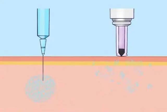 仟龙谈谈无针注射器是如何进行胰岛素注入的