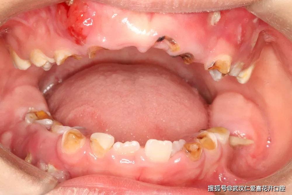 照片,从照片里面可以看出,瑞瑞几乎全口都是蛀牙,大部分牙齿仅剩残冠