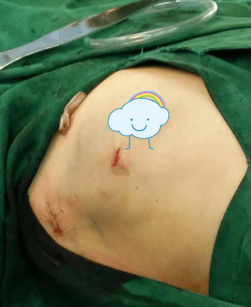济南中科甲乳医院乳癌保乳专家李维亚延续生命留住美丽