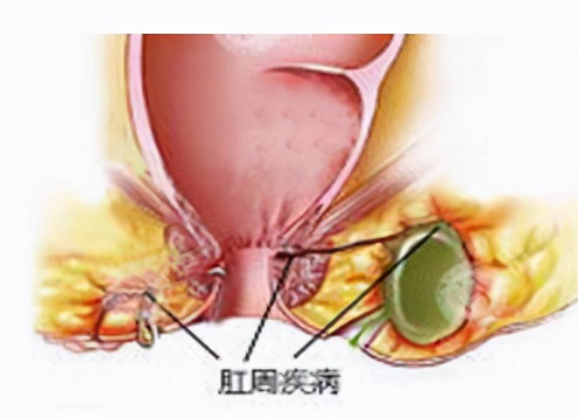 肛肠博士程一乘25岁小伙肛周脓肿难忍深究为何肛周脓肿钟情于男性