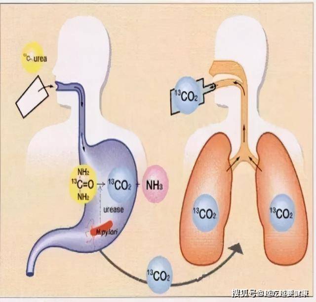 原创碳14明明有放射性,为什么查体时还用它做呼气试验,真的安全吗?