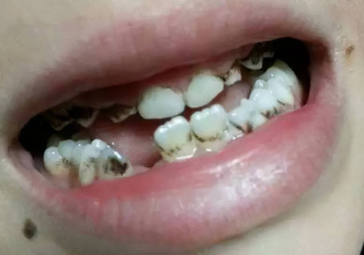 相关研究表明,虫牙是细菌,饮食以及唾液共同作用产生的,缺少其中任何