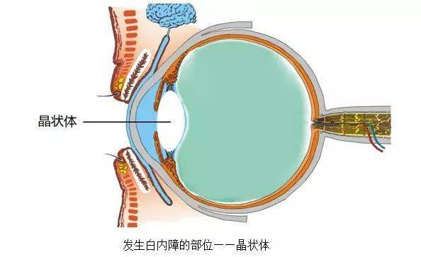 白内障主要症状是什么?上海眼科医生提醒:注意这三大误区!