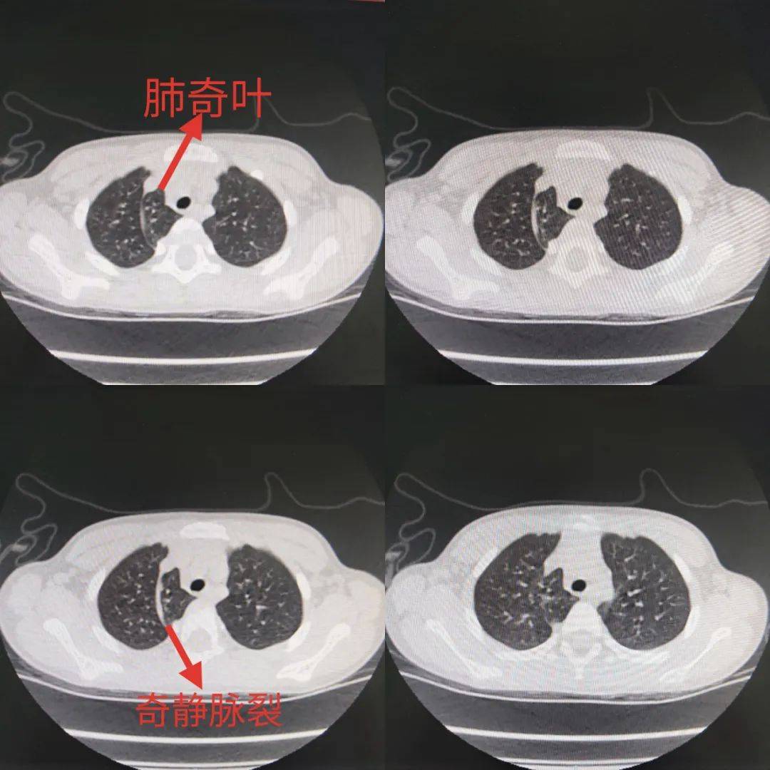 4~1.奇叶多发生于右肺上叶纵隔旁侧 偶有左肺奇叶形成者[2.