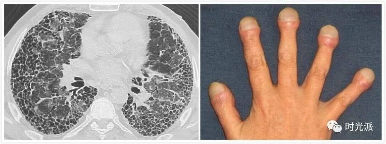 图注:严重纤维化而丧失功能的"蜂窝肺"与长期缺氧导致的"杵状指"