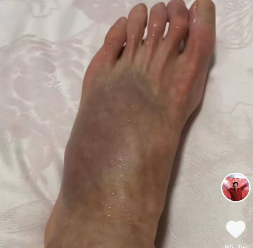张国伟好消息!骨折后保守治疗,脚已渐渐消肿,复出首秀