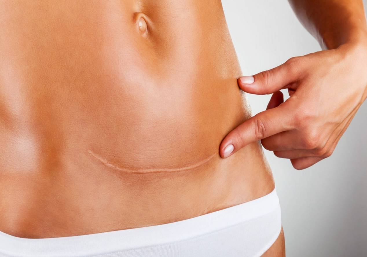 疤痕体质对剖腹产有什么影响？增生还只是小问题,这些比较严重