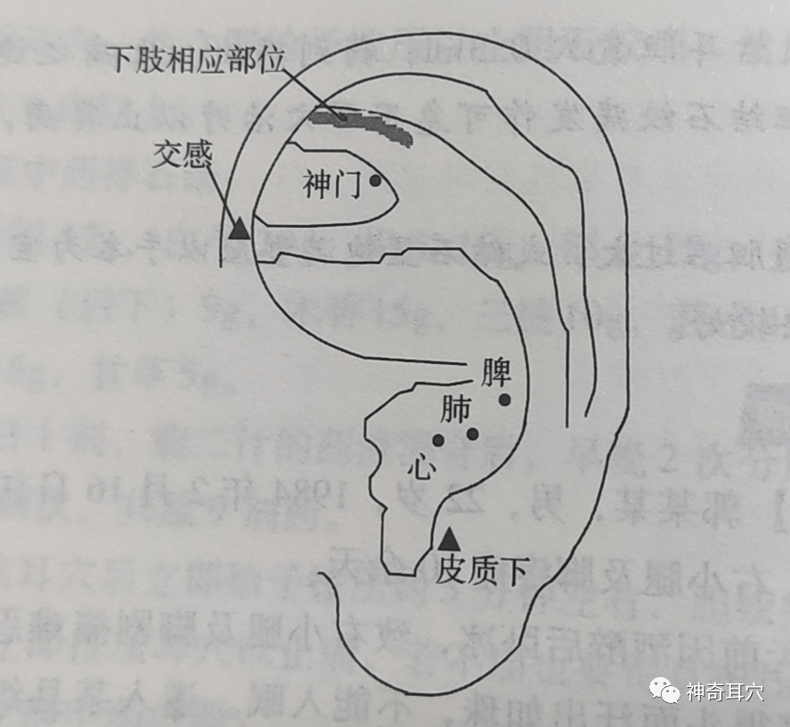 【治疗 取耳穴:脾,肺,心,交感,神门,皮质下,下肢相应部位