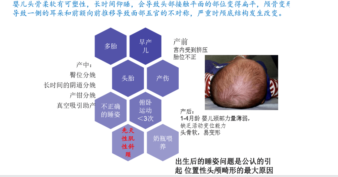 新生儿先天性头颅畸形头颅矫正