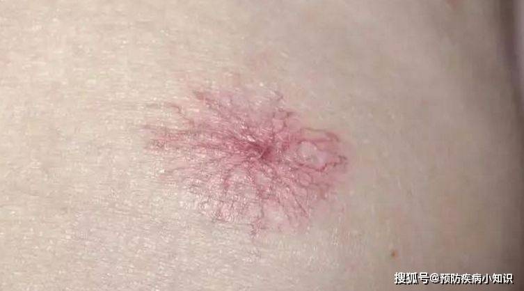 异常2,出现蜘蛛痣