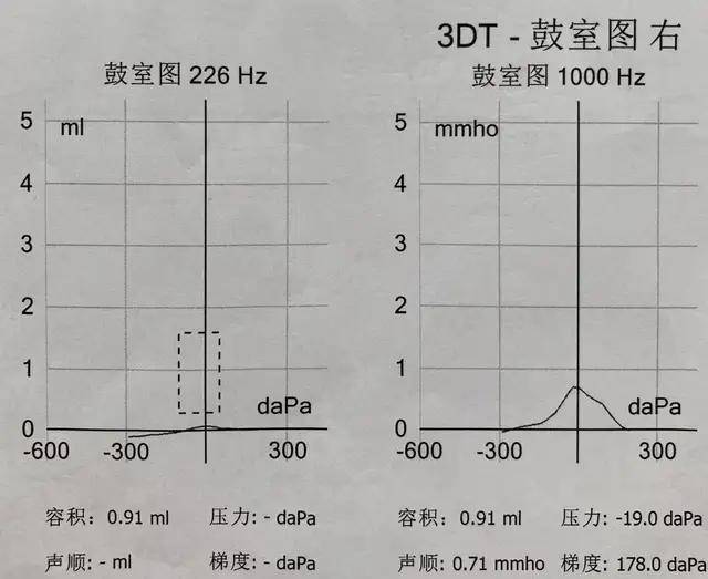 侧别1k hz鼓室曲线226 hz鼓室曲线鼓