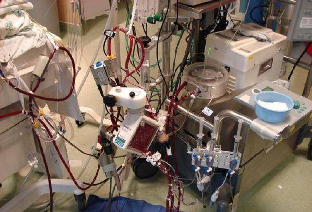 icu神器ecmo:开机成本7万,技术被国外垄断,中国没有权