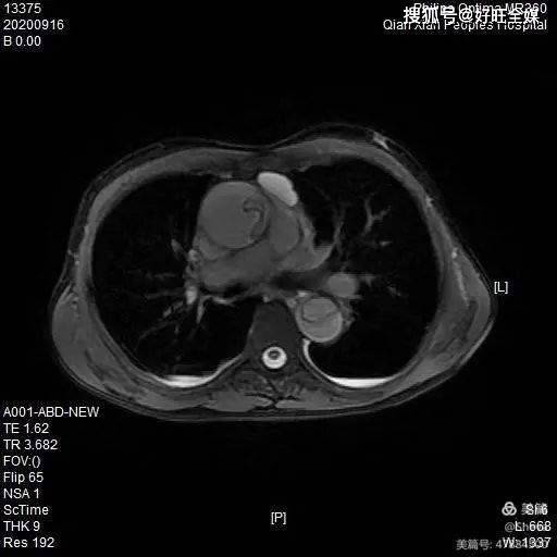 ct平扫-肝癌骨盆三维重建-右侧髋臼前柱及耻骨下支骨折肝脏增强ct扫描