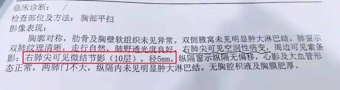 查出肺结节一定会癌变身体出现这3种变化需提高警惕