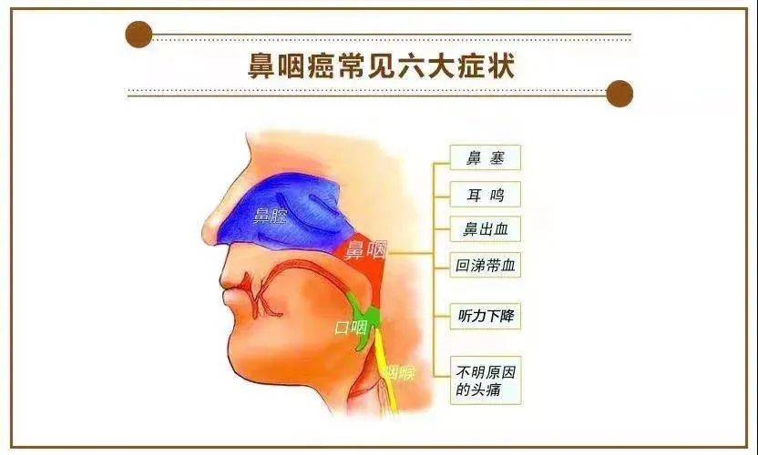 鼻咽癌来临前有这四大征兆早知道就是救命