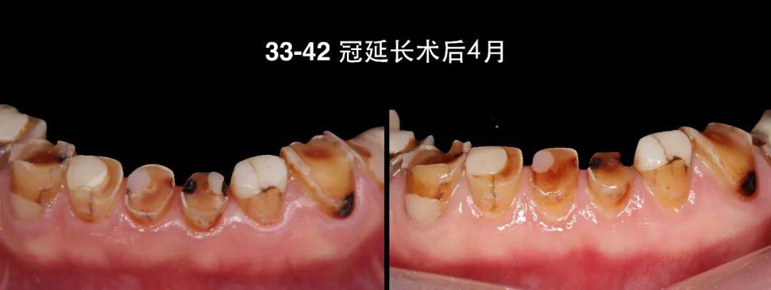 冠延长导板引导下完成下前牙牙冠延长术itrs种植导板引导下完成12,15