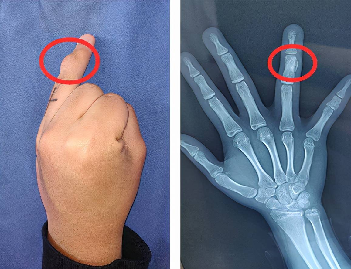 少年手指肿了两年这种初发在5至15岁间的肿瘤究竟是什么