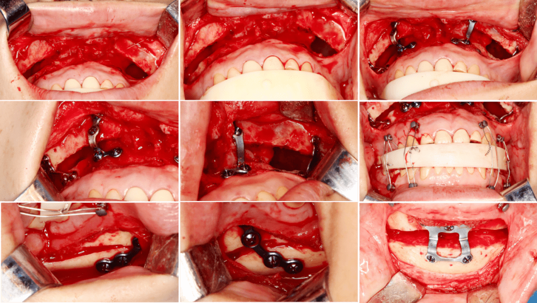 利用下颌位置及咬合板固定进行上颌lefort i型截骨;同时进行颏成型术